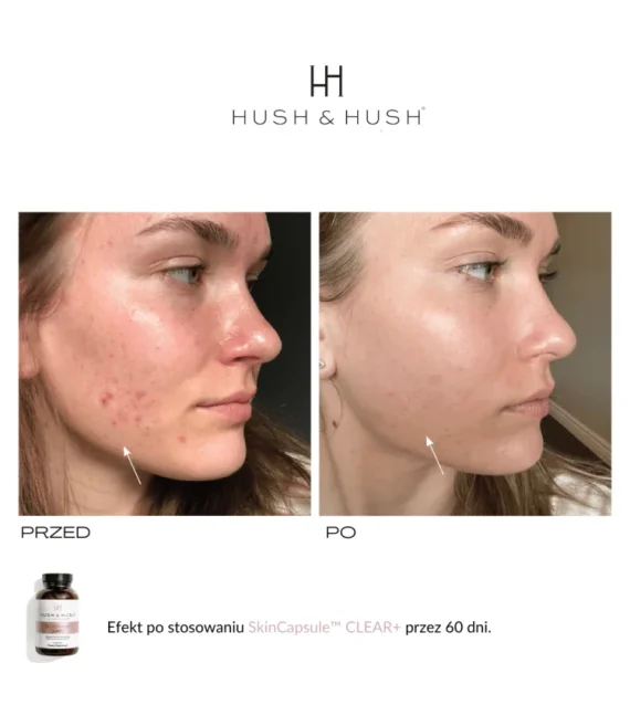 Hush & Hush® • Skin Capsule Clear+ • Wegański suplement diety wspierający skórę w przebiegu trądziku • 60sz - obrazek 2