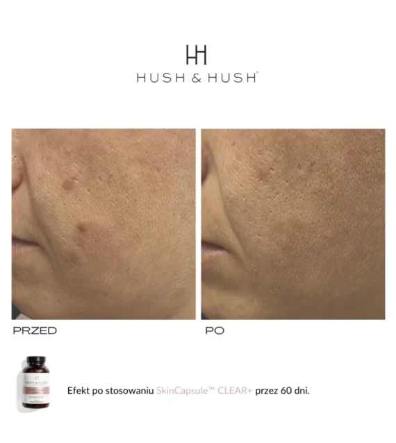 Hush & Hush® • Skin Capsule Clear+ • Wegański suplement diety wspierający skórę w przebiegu trądziku • 60sz - obrazek 4