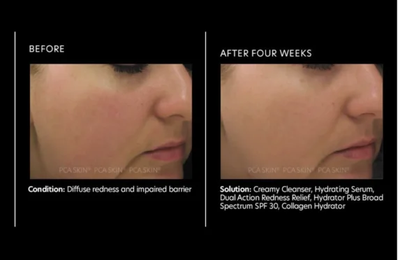 PCA Skin® • Dual Action Redness Relief • Serum regenerujące dla skóry wrażliwej • 30ml - obrazek 3